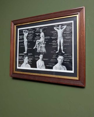 Early 1900s medical diagram with nude patients in antique wooden frame