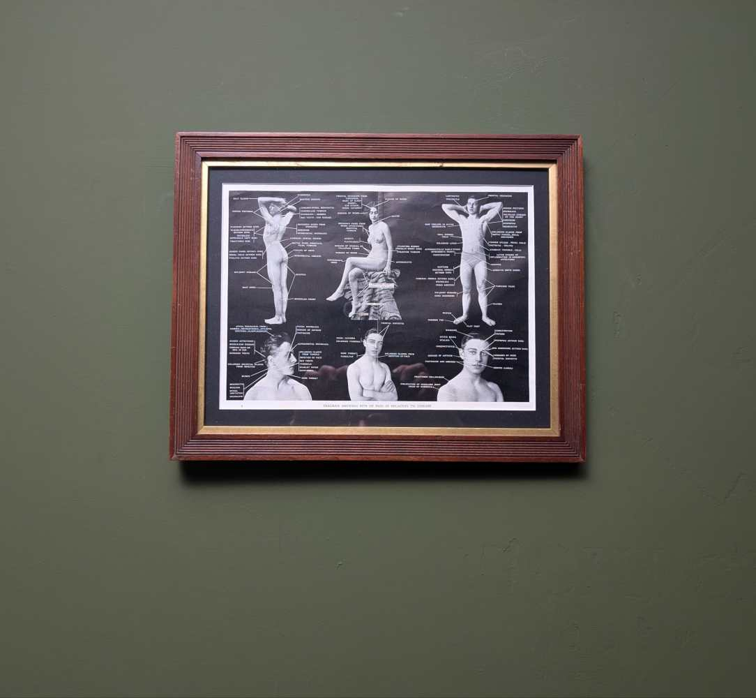 Early 1900s medical diagram with nude patients in antique wooden frame - Image 9