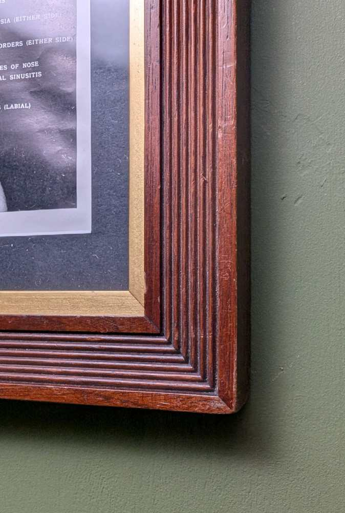 Early 1900s medical diagram with nude patients in antique wooden frame - Image 8