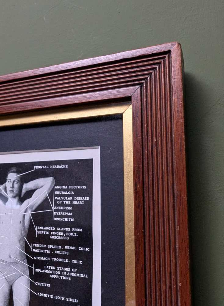 Early 1900s medical diagram with nude patients in antique wooden frame - Image 12