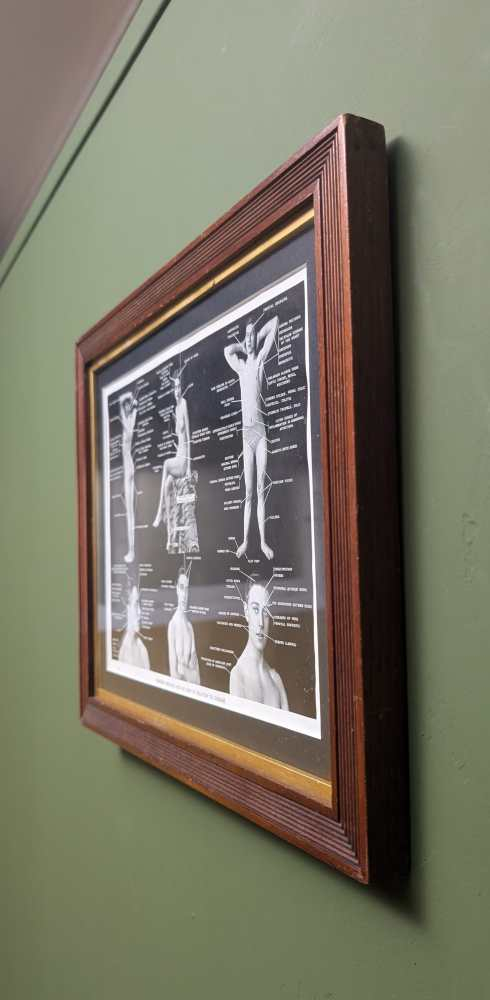 Early 1900s medical diagram with nude patients in antique wooden frame - Image 4