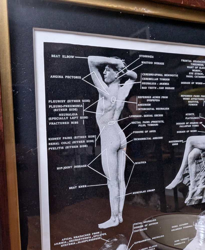 Early 1900s medical diagram with nude patients in antique wooden frame - Image 5