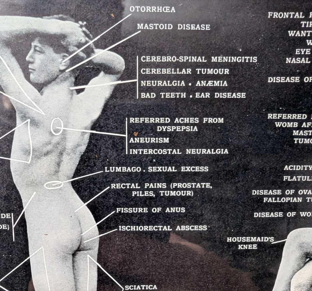 Early 1900s medical diagram with nude patients in antique wooden frame - Image 10