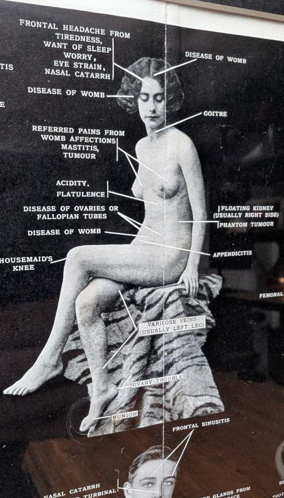 Early 1900s medical diagram with nude patients in antique wooden frame - Image 3