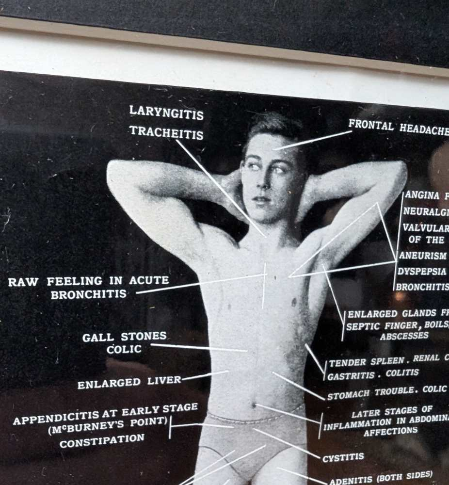 Early 1900s medical diagram with nude patients in antique wooden frame - Image 18