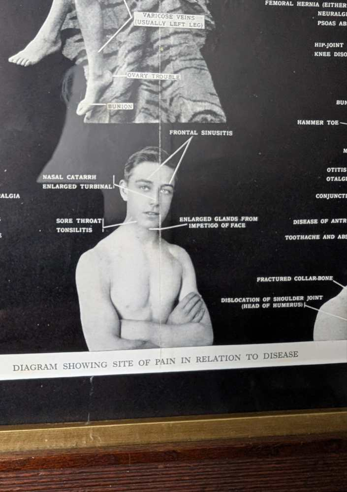 Early 1900s medical diagram with nude patients in antique wooden frame - Image 7