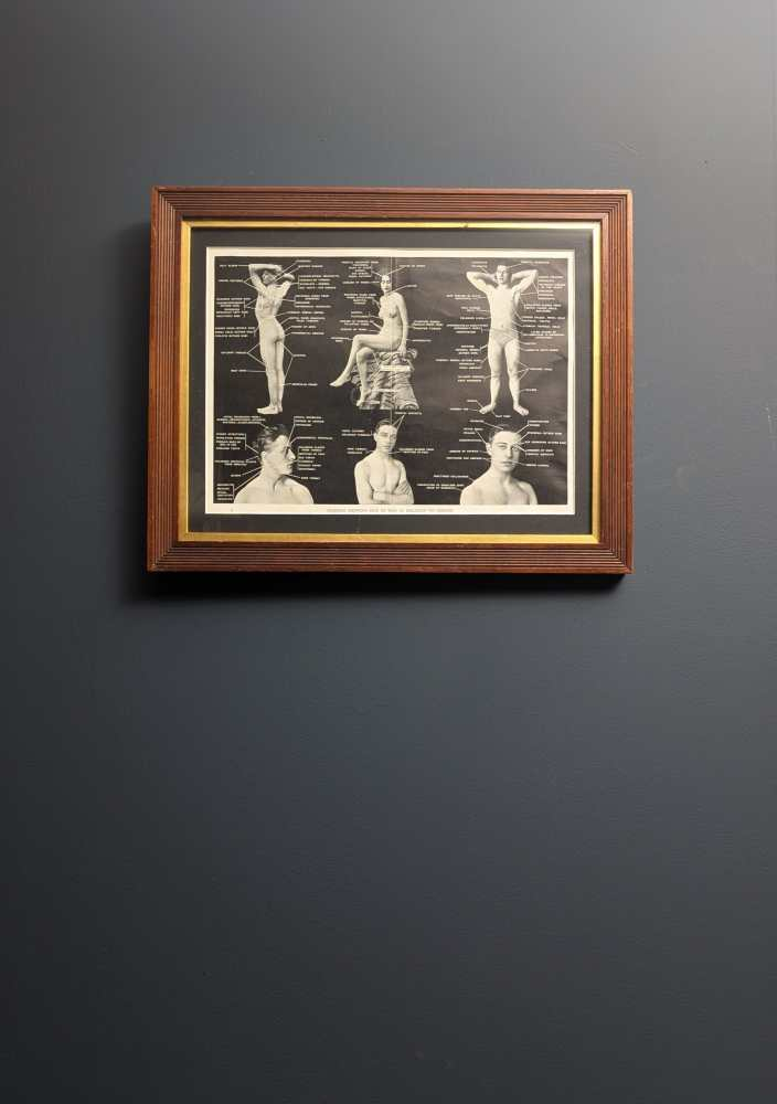 Early 1900s medical diagram with nude patients in antique wooden frame - Image 2