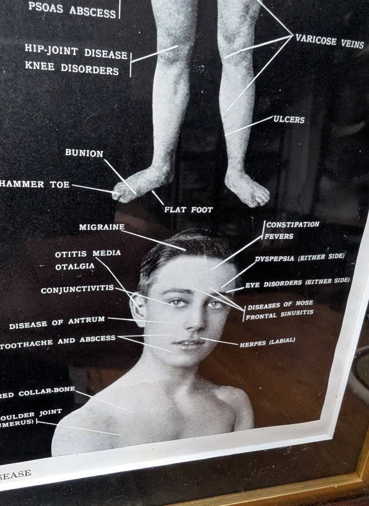 Early 1900s medical diagram with nude patients in antique wooden frame - Image 11