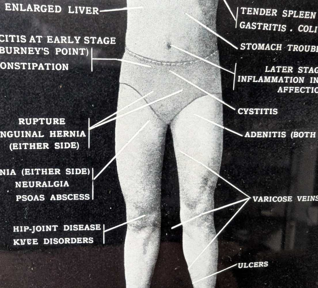 Early 1900s medical diagram with nude patients in antique wooden frame - Image 13