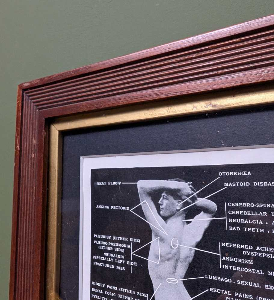 Early 1900s medical diagram with nude patients in antique wooden frame - Image 6