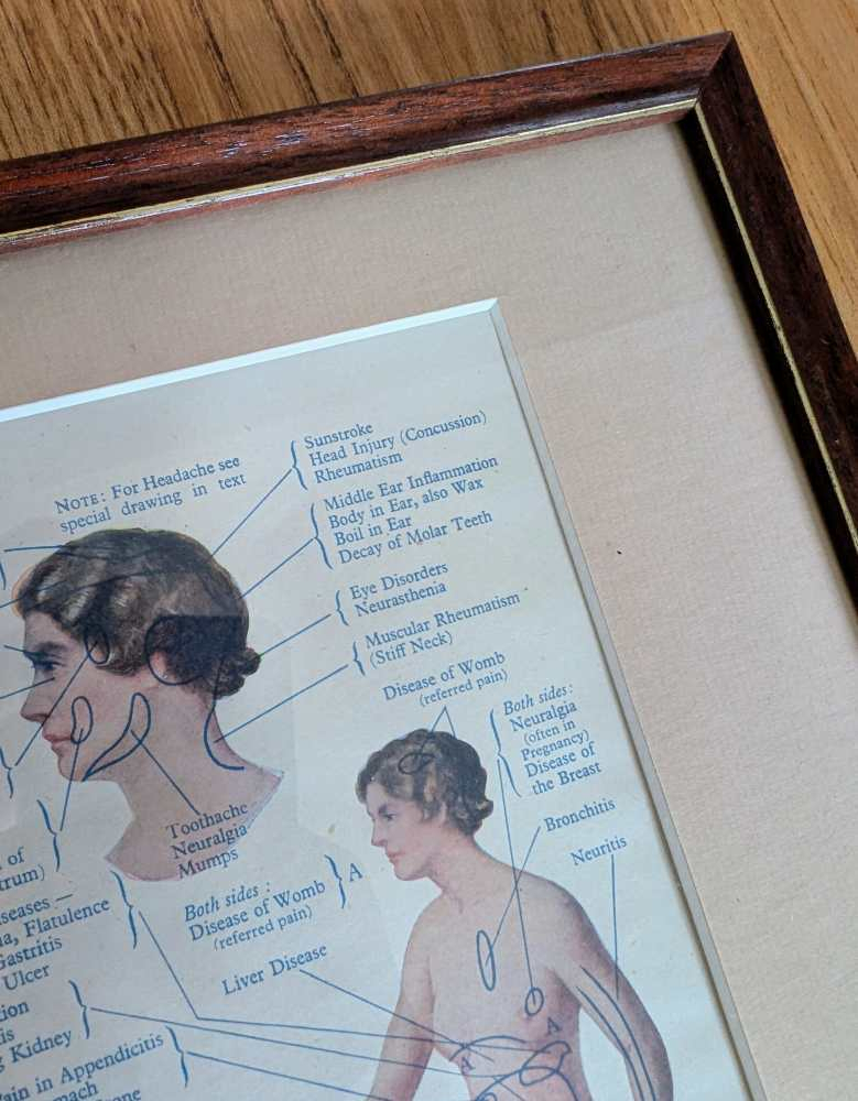 Early 20th century pair of male and female medical diagnosis diagrams of patients labelled with symptoms - Image 11
